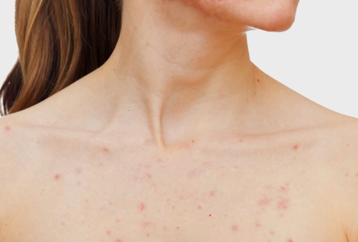 Body Acne Be Gone!